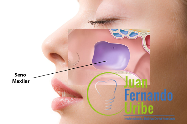 ELEVACIÓN DEL SENO MAXILAR Y COLOCACIÓN DE IMPLANTES INMEDIATOS