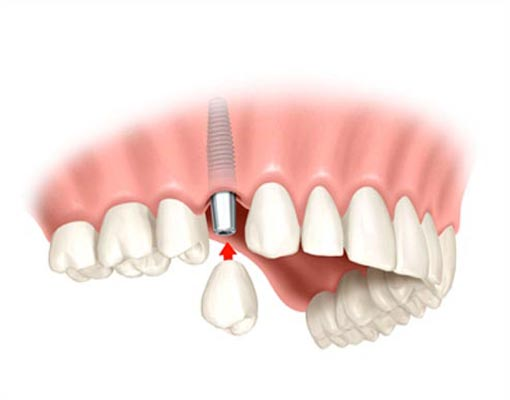 Prótesis dental – ¿por qué es necesaria?