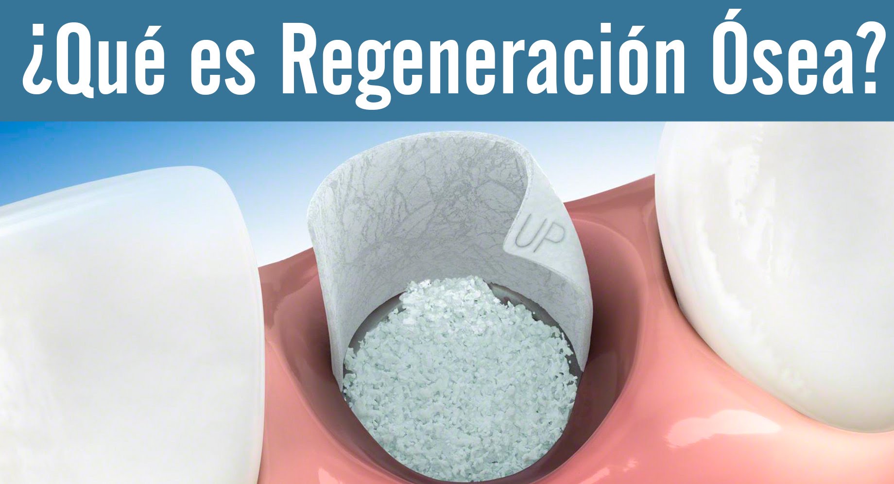 (Español) ¿Que es regeneración Osea?